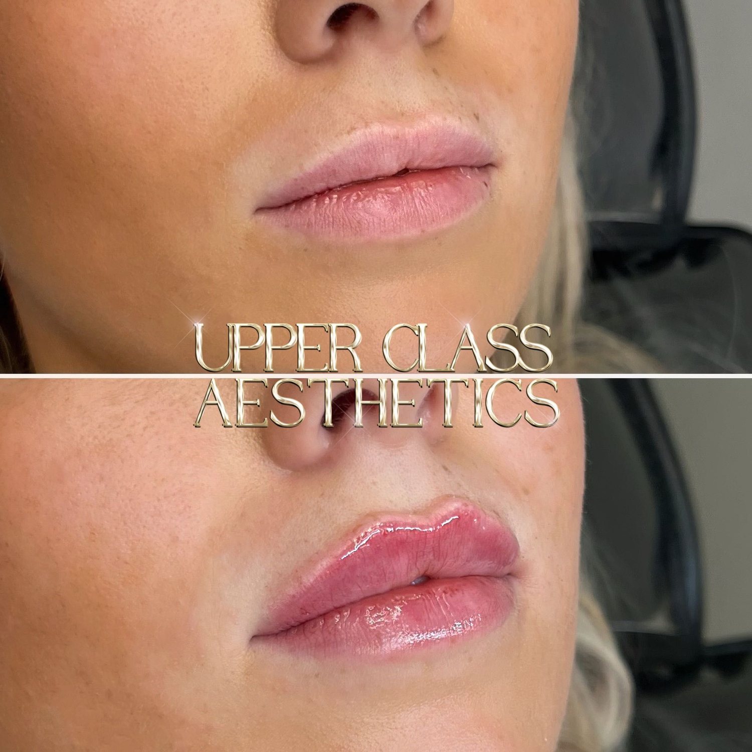 A client’s lips before and after treatment, example 3