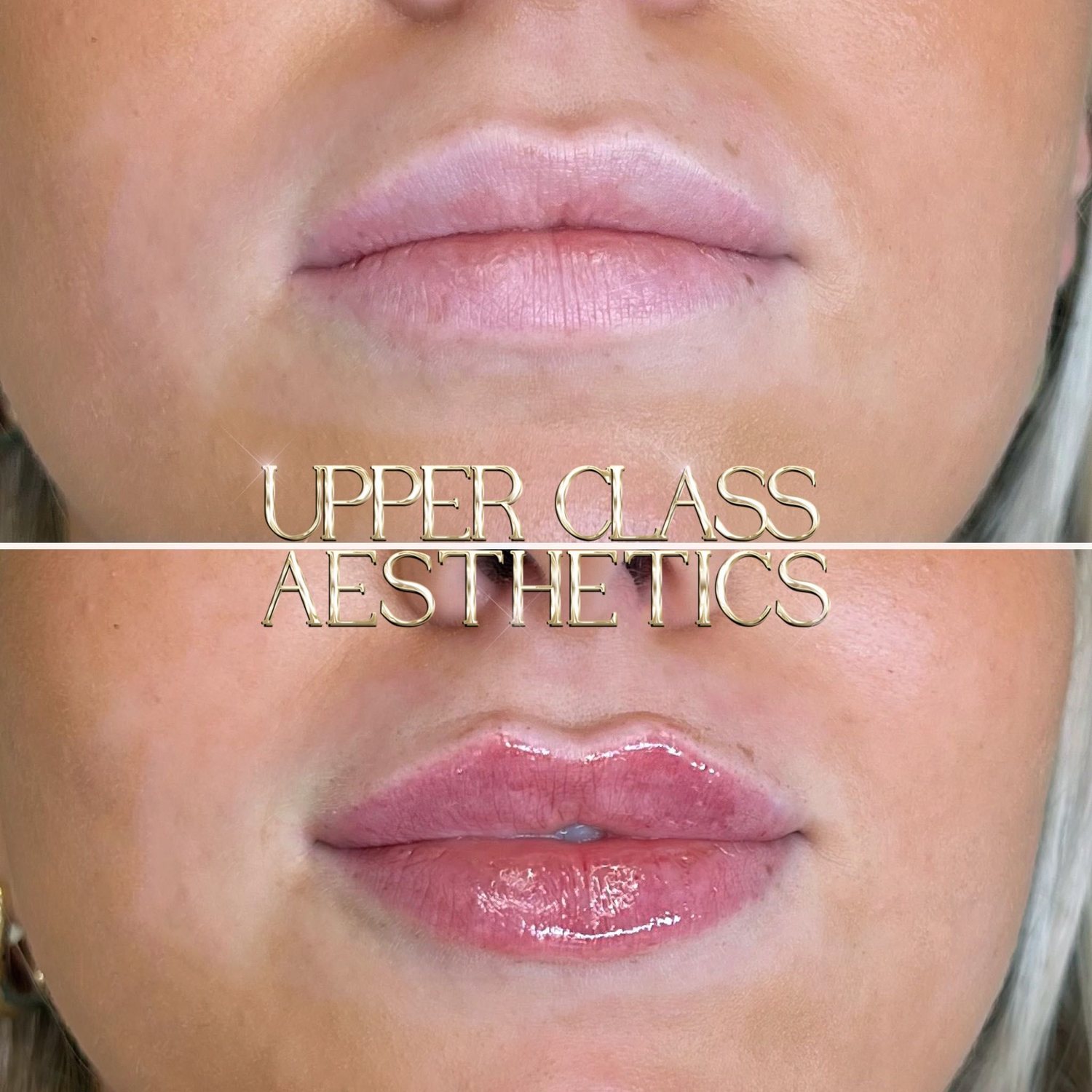 A client’s lips before and after treatment, example 5