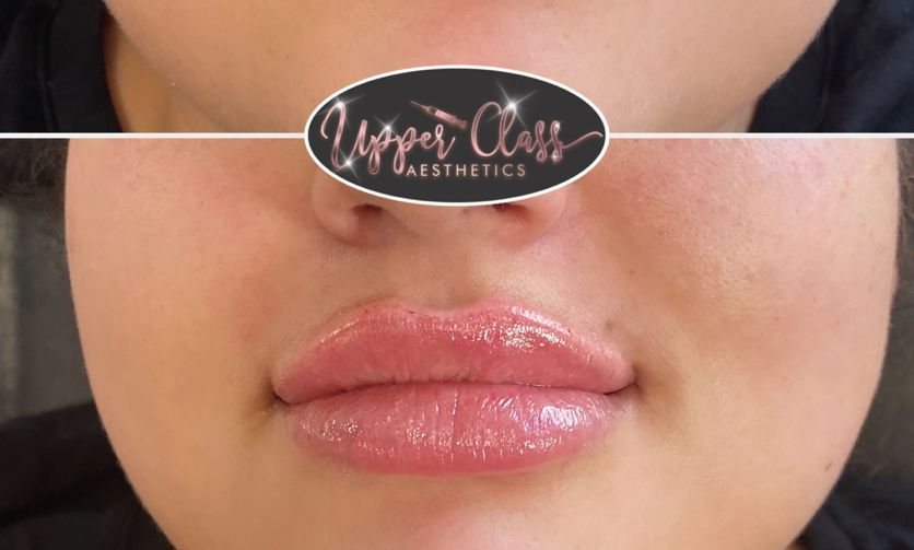 A client’s lips after treatment, example 1