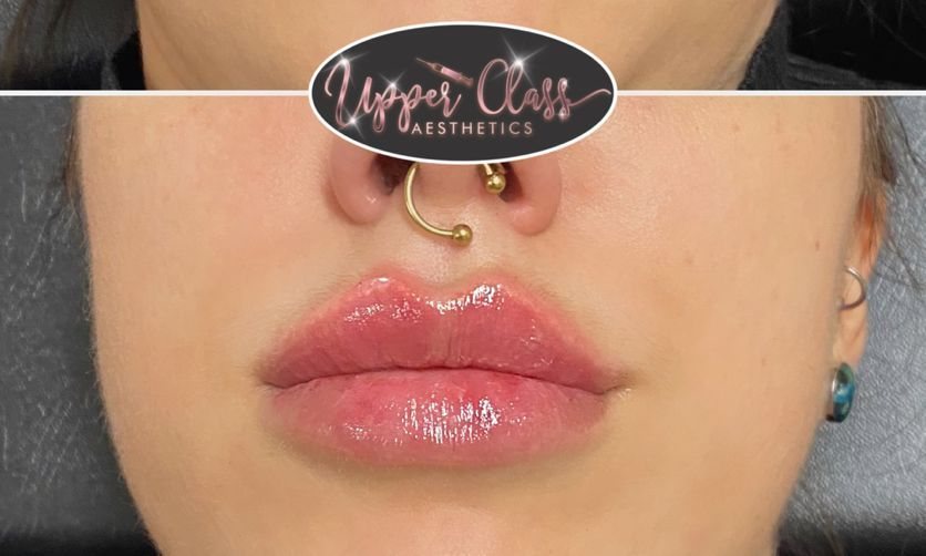 A client’s lips after treatment, example 2