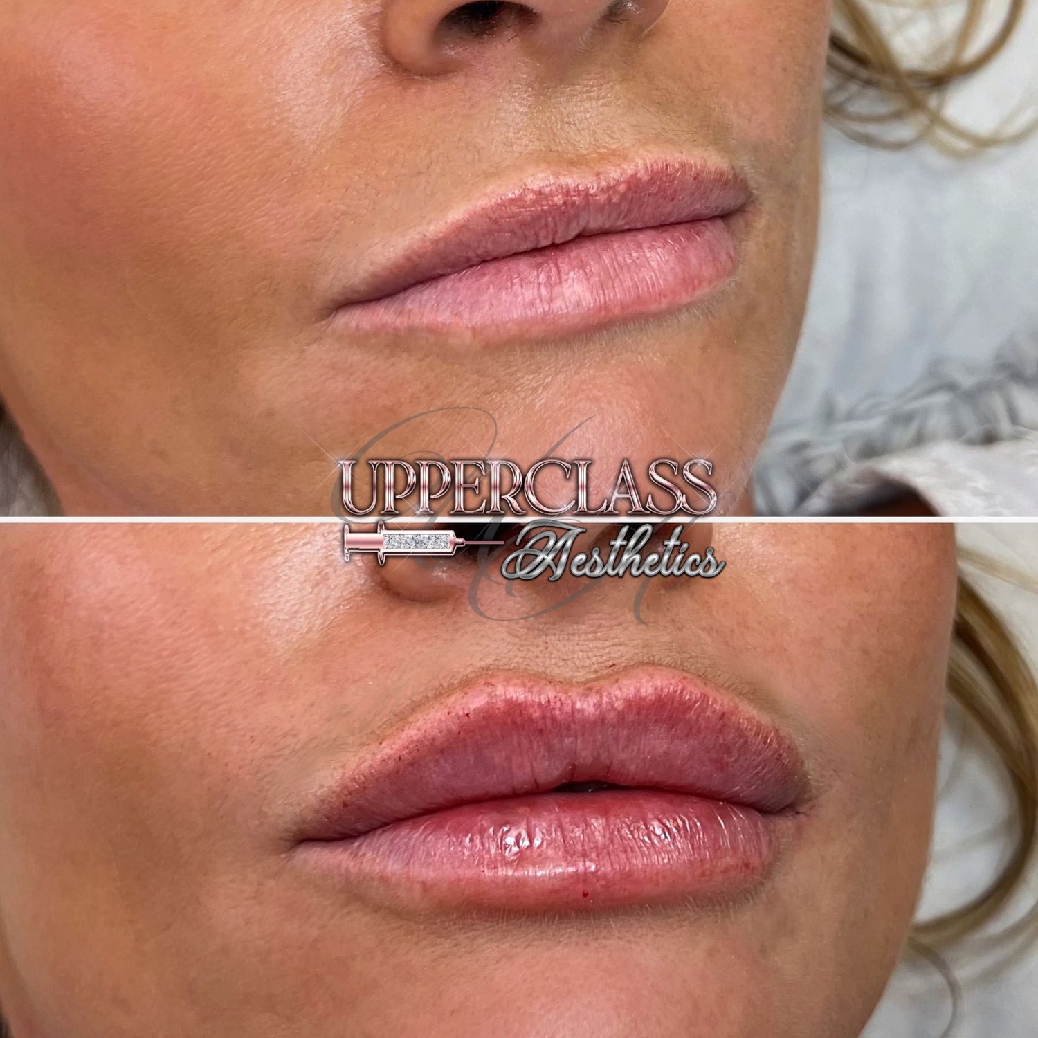A client’s lips before and after treatment, example 2