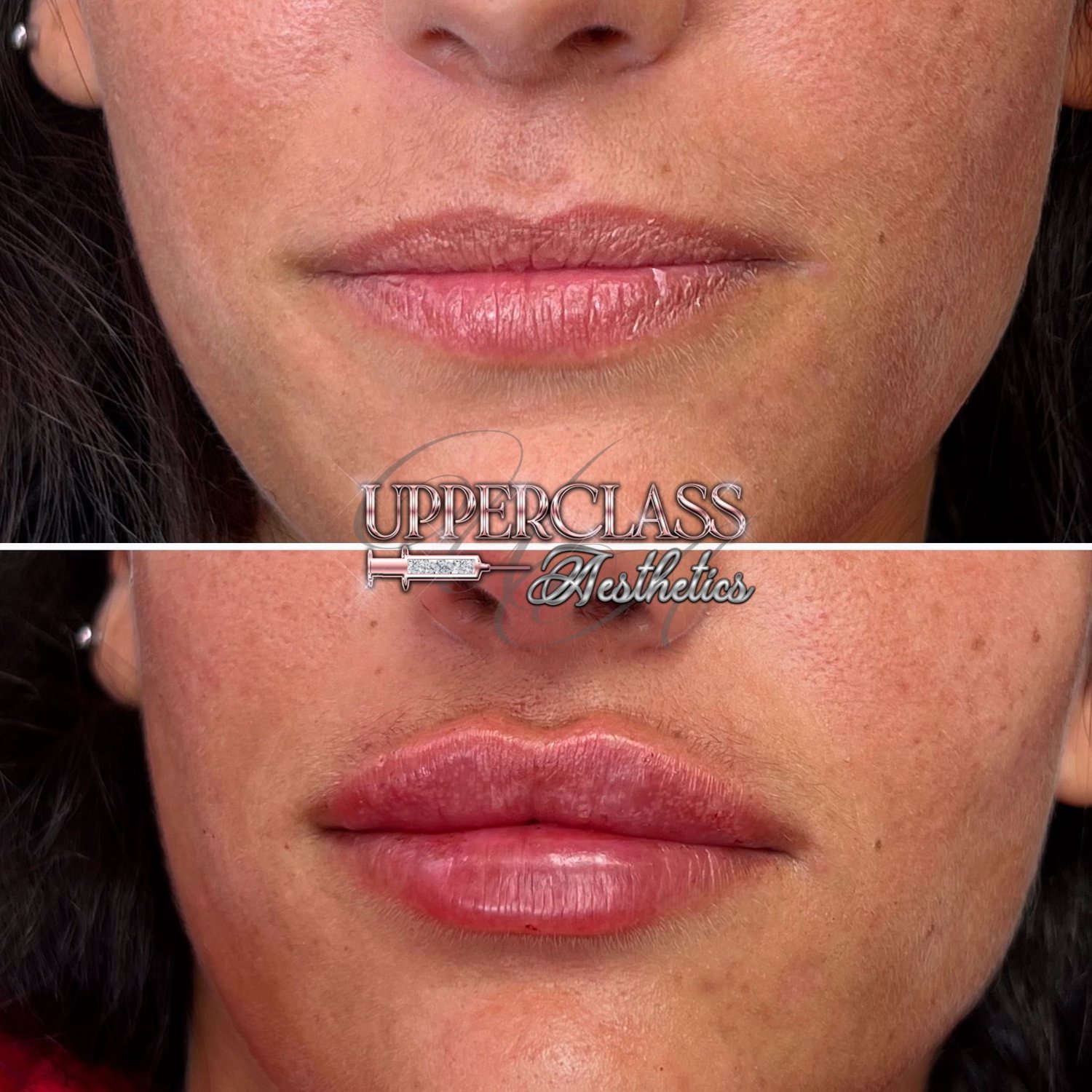 A client’s lips before and after treatment, example 4
