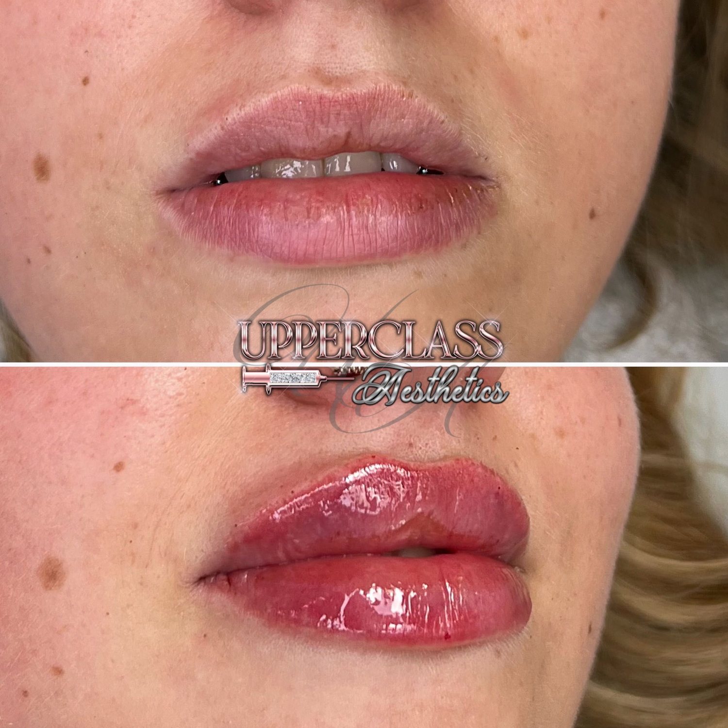 A client’s lips before and after treatment, example 6