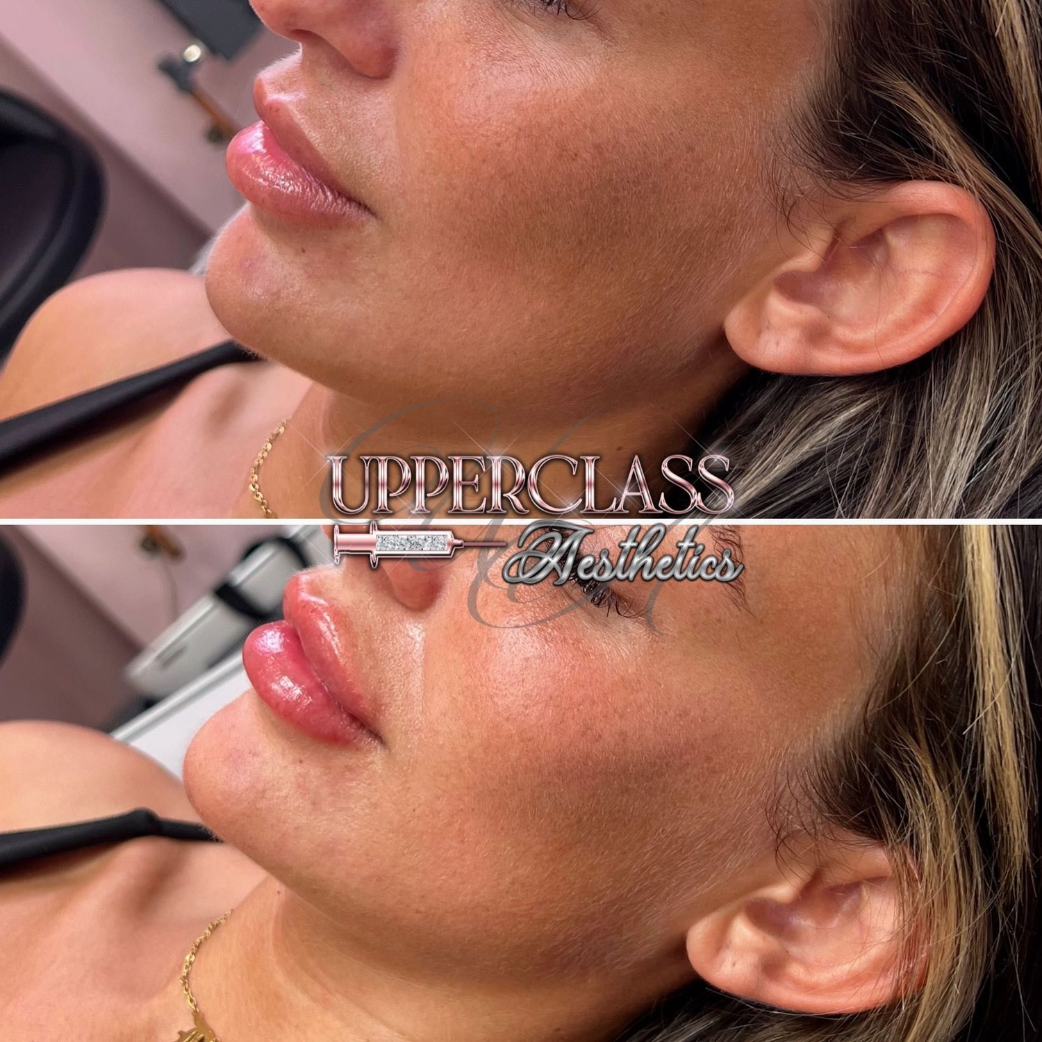 A client’s lips before and after treatment, example 8